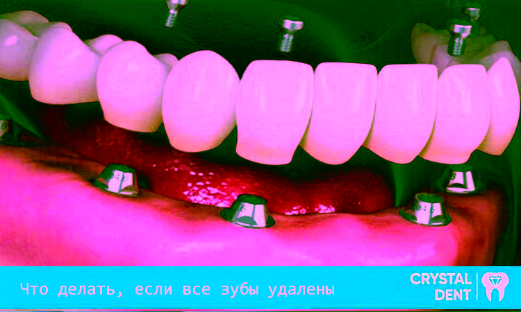 Восстановление зубного ряда, если все зубы удалены
