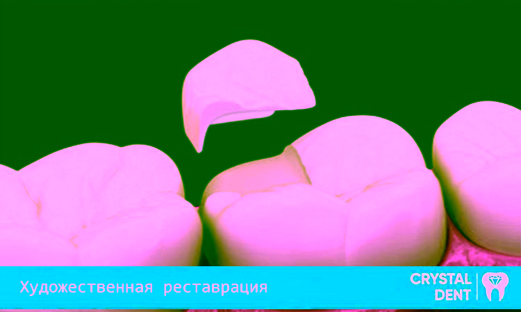Преимущества художественной реставрации зубов
