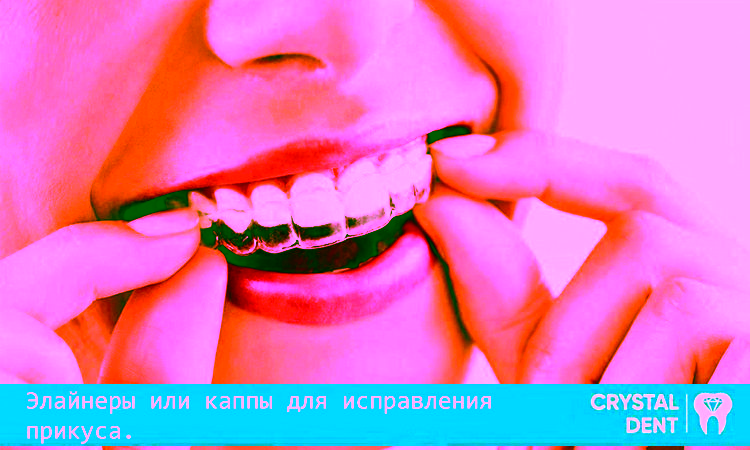 Каппы-элайнеры: все, что нужно знать перед использованием