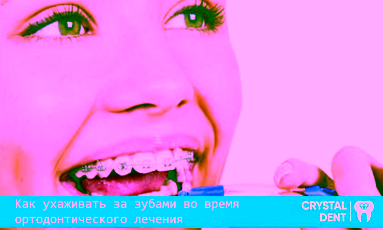 Правила ухода за полостью рта при ортодонтическом лечении