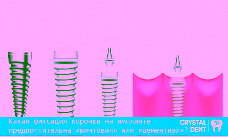 Сравнение цементной и винтовой фиксации коронок на имплантах
