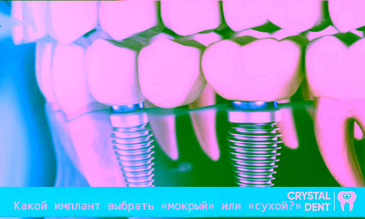 Який імплант вибрати “мокрий” або “сухий”?