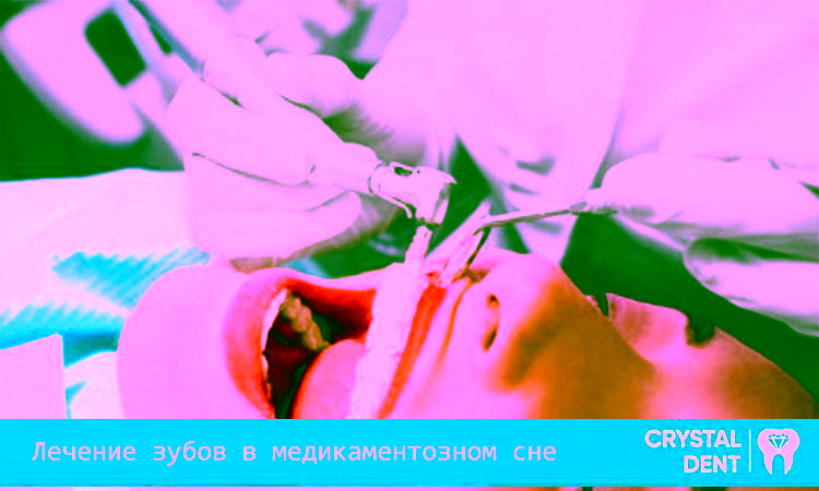 Особенности лечения зубов в медикаментозном сне
