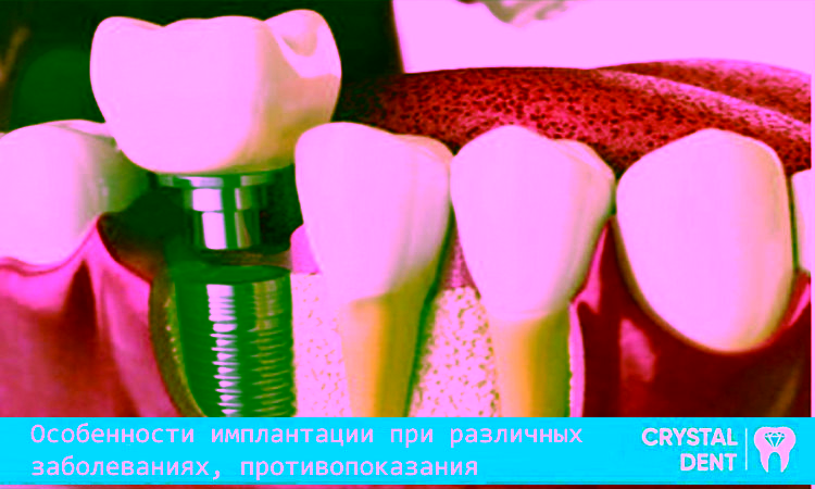 Особенности имплантации при разных болезнях – противопоказания