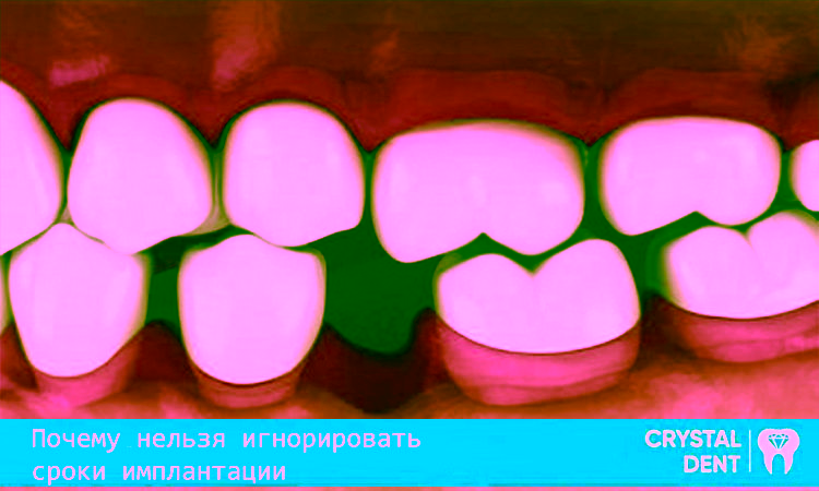 Почему нельзя игнорировать сроки имплантации