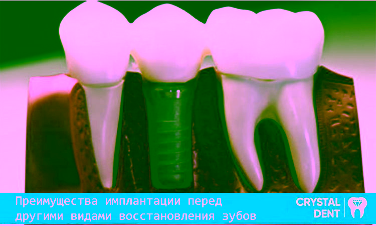 Все плюсы имплантации перед другими методами восстановления