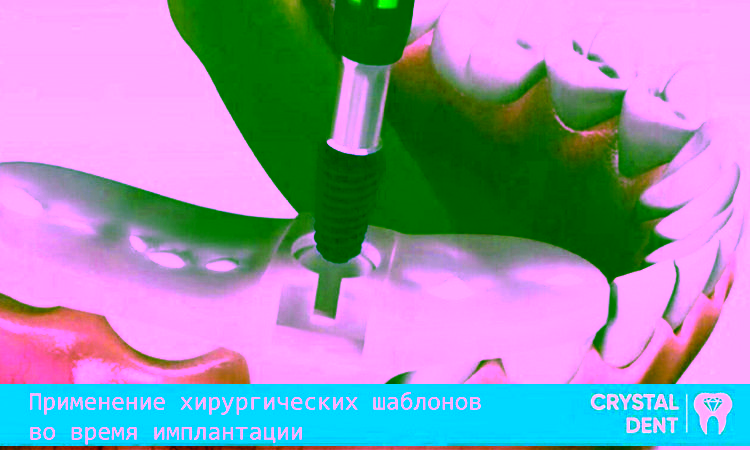 Что такое хирургический шаблон, их применение