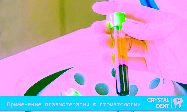 Применение плазмотерапии в стоматологии