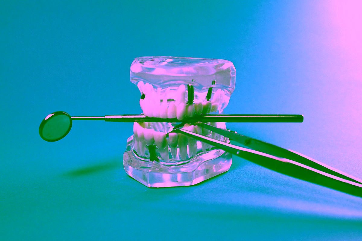 Импланты: преимущества и недостатки, показания и противопоказания к установке, возможные риски