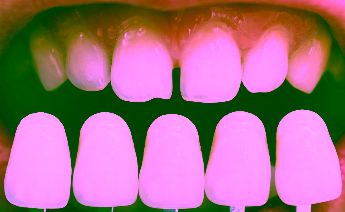 Как ставят виниры: этапы процедуры и что следует учесть перед ней