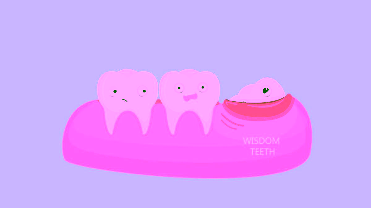 Все, что нужно знать о зубах мудрости