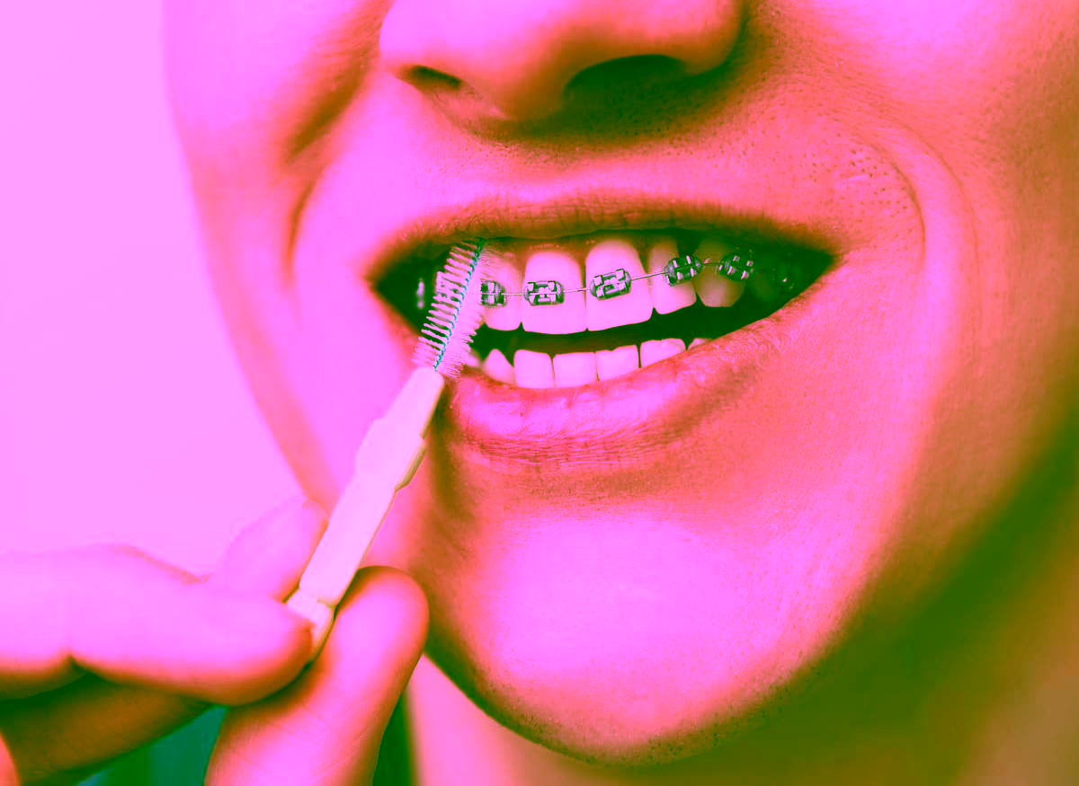 Стоматологические ершики: что это такое и для чего нужны