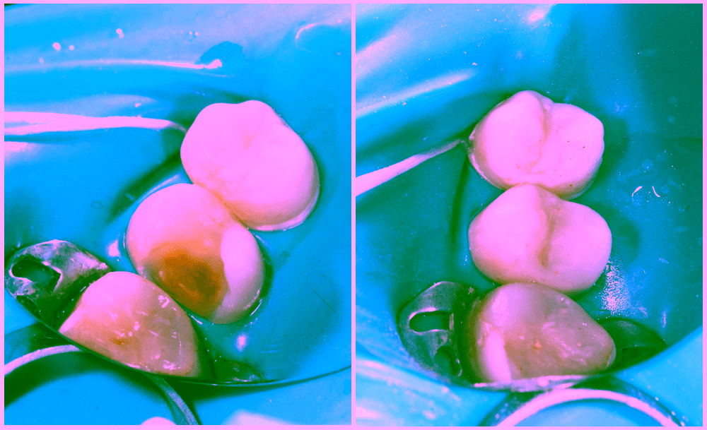 Зачем используется коффердам в стоматологии?