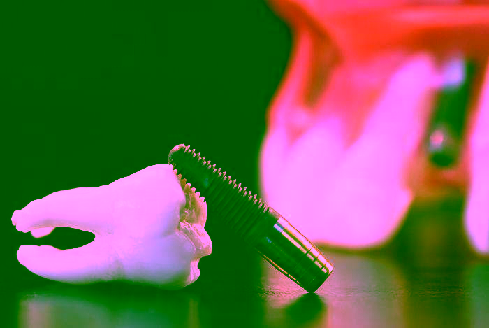 Сколько стоит имплантация зубов