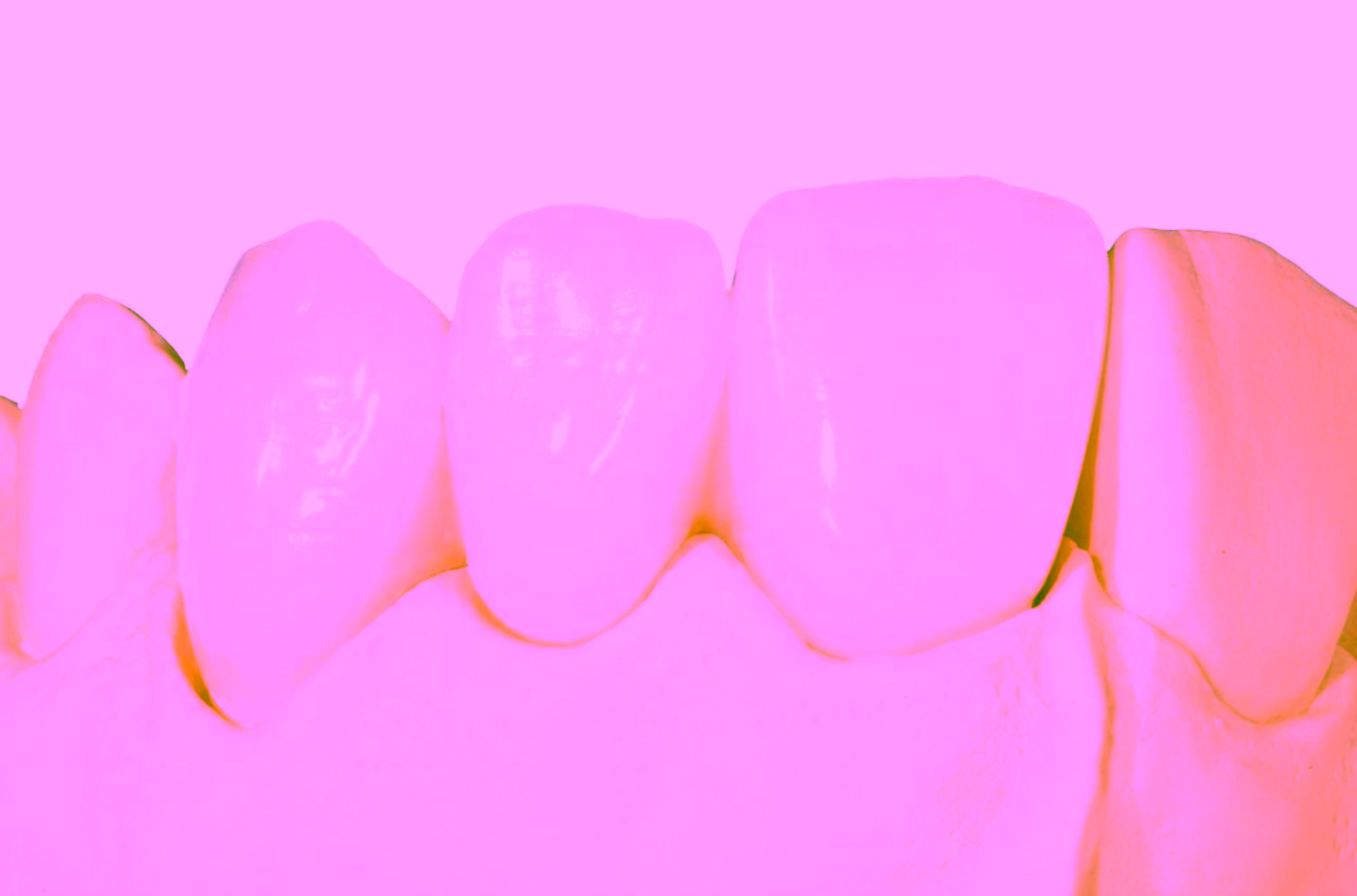 Прессованная керамика emax