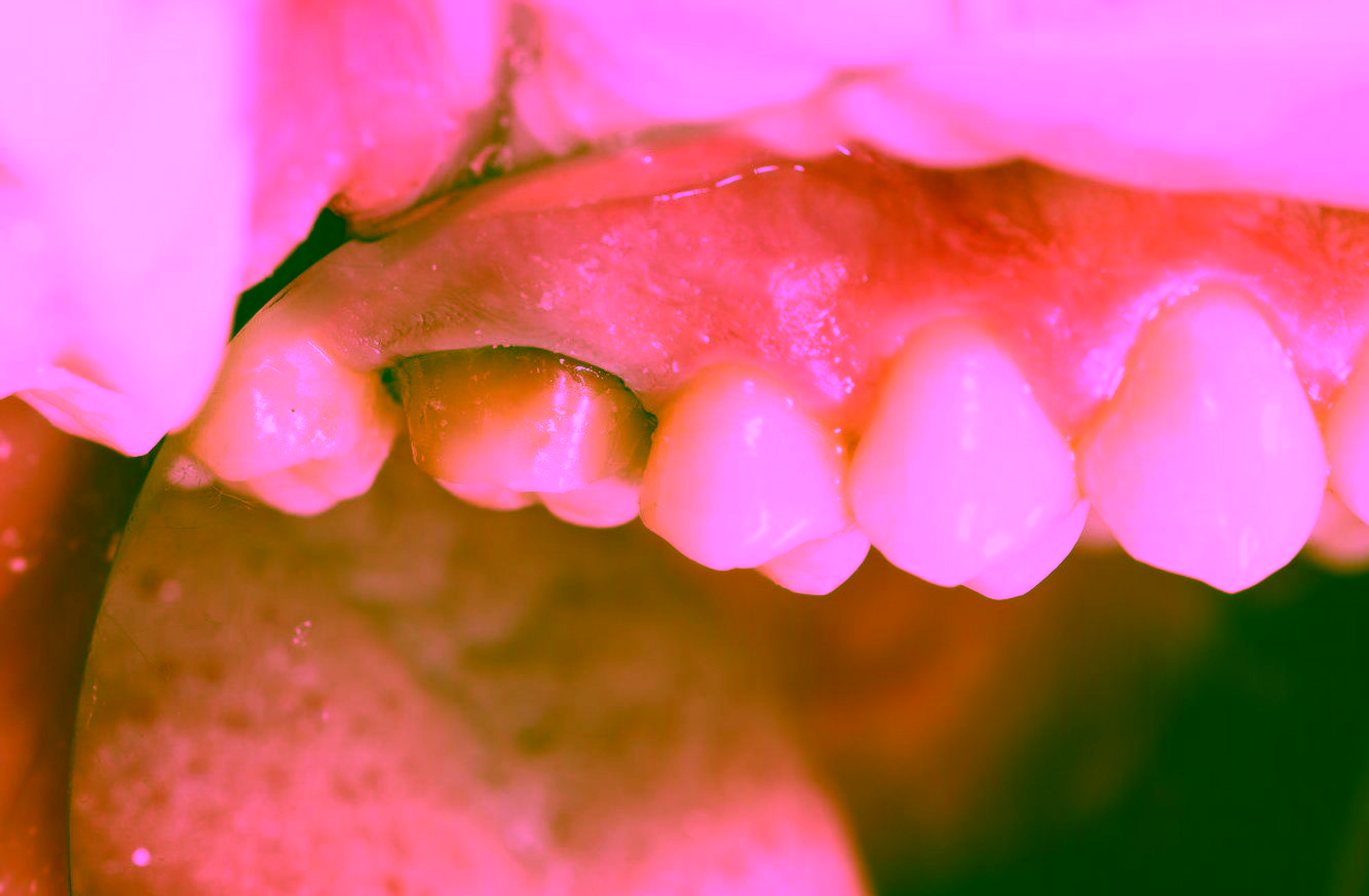 Восстановление Эстетики