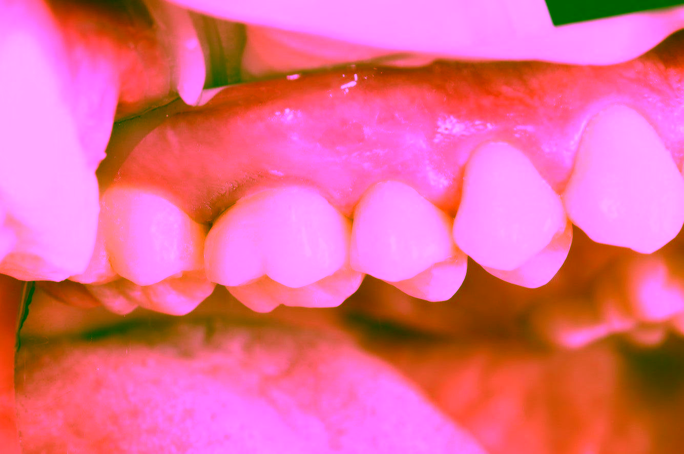 Восстановление Эстетики