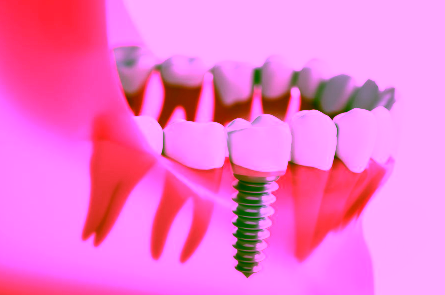 Зубные импланты Straumann