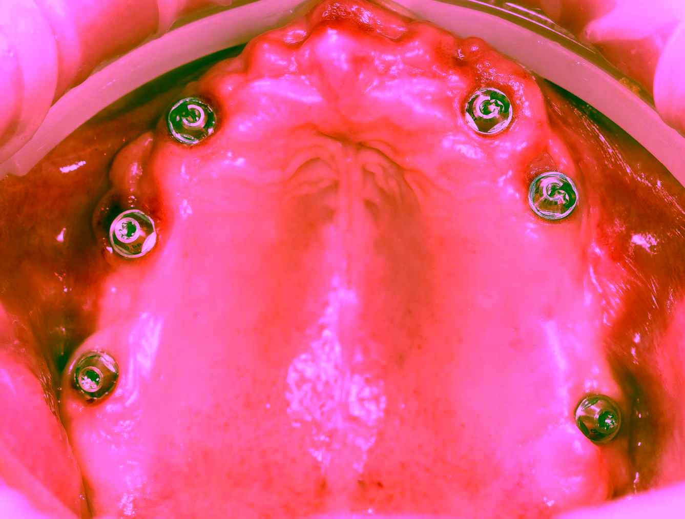 Протезирование