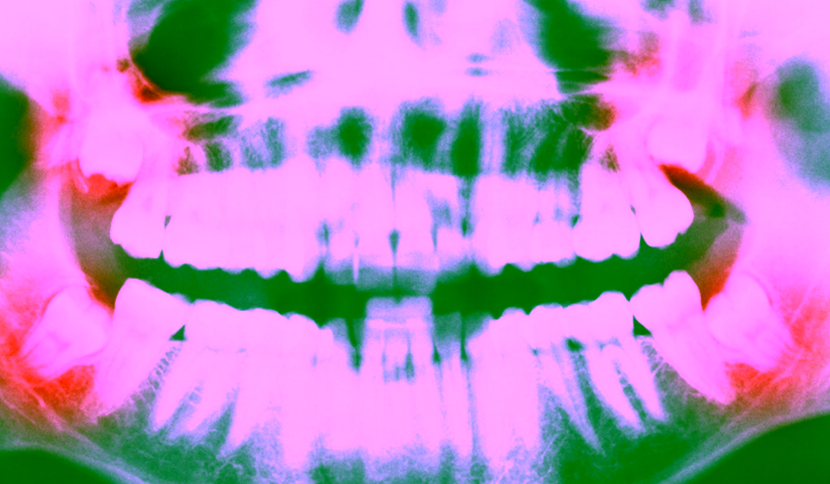 Что такое ретинированный зуб мудрости и нужно ли его удалять?