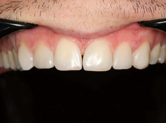 Восстановление Эстетики